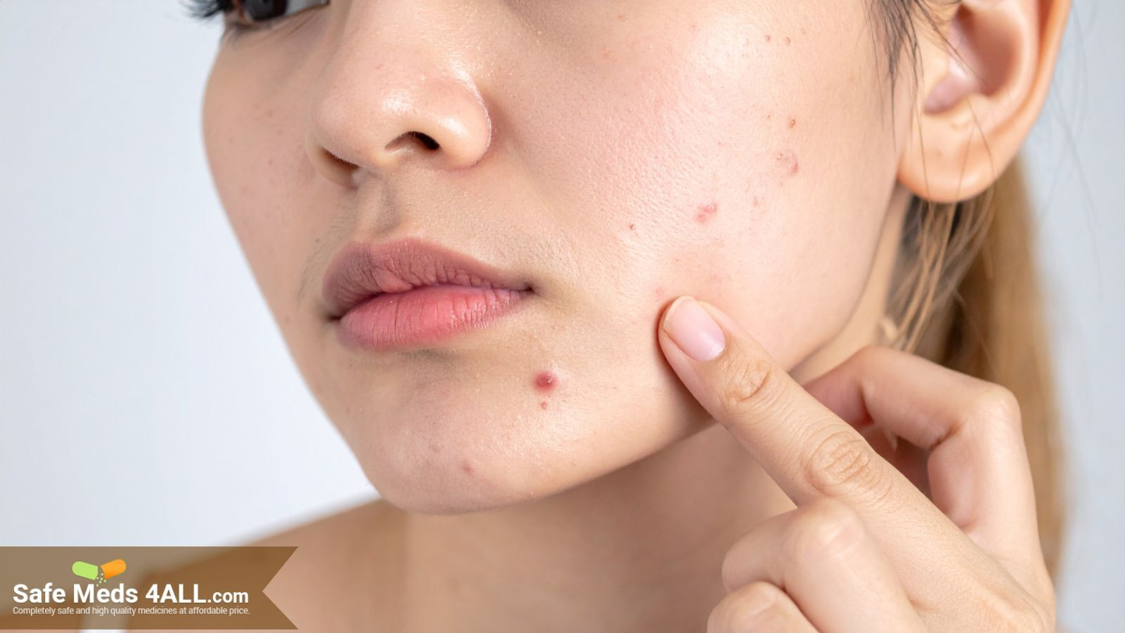 A woman displaying acne on her face.