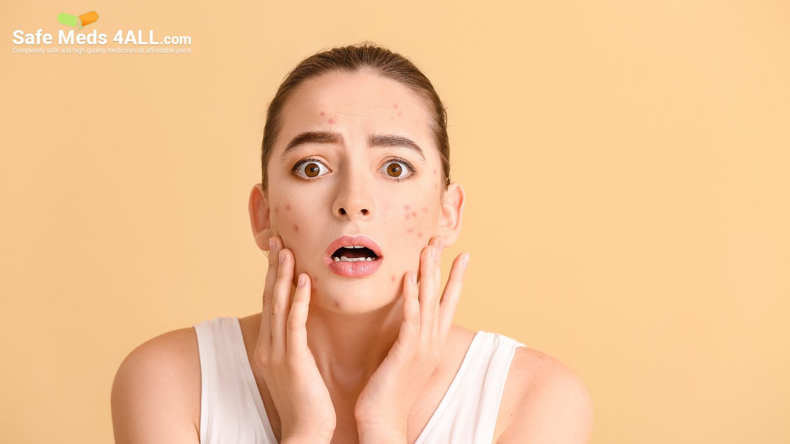 A girl with acne on her face applying Retin-A Gel.